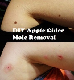 Danger of DYI mole removal